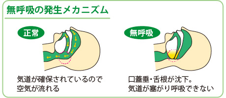 無呼吸の発生メカニズム