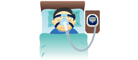 CPAP(シーパップ)